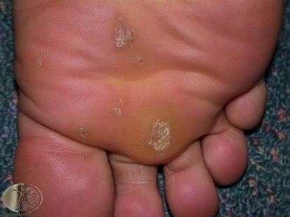 Plantar warts