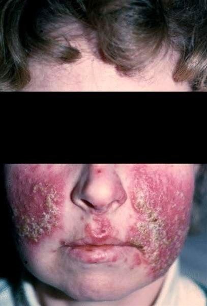 Rosacea, uttalt.
