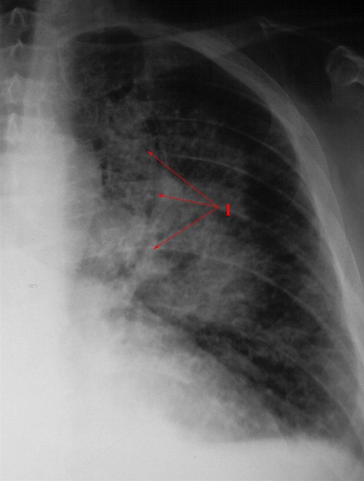 Hjertesvikt, alvorlig