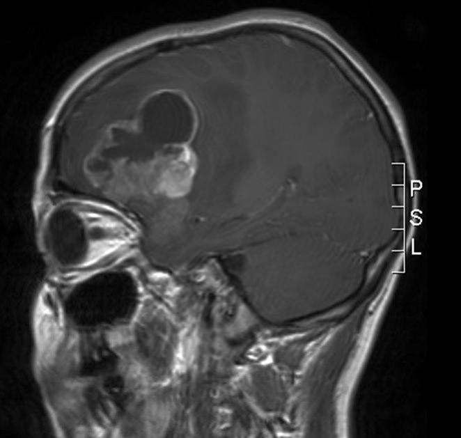 anaplastisk ependymom 1