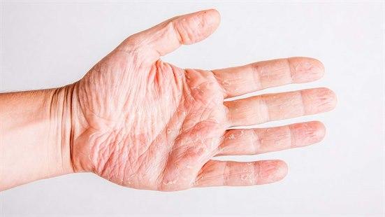 Nærbilde av en håndflate med atopisk eksem