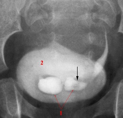 Ureterocele (urografi)