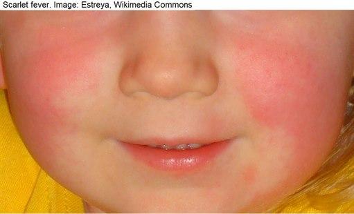 Scarlet  fever