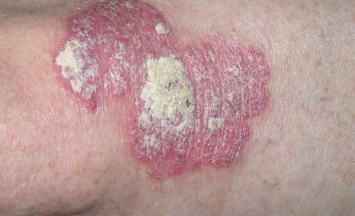 Psoriasis, plakk