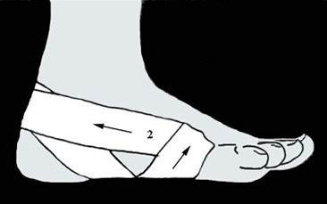 Fotsåleteiping bilde#2