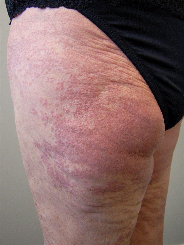 Utbredt granuloma annulare