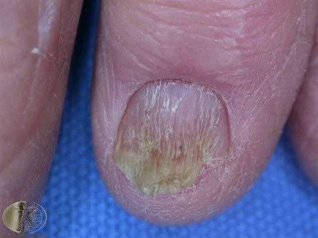 Lichen planus, negl