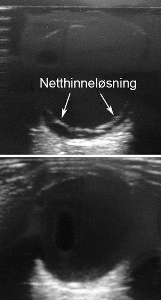 netthinneløsning ultralyd