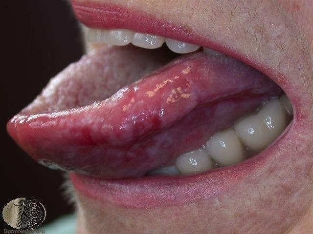 Fotoet viser oral lichen planus