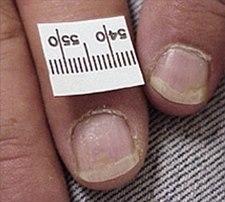 Negleforandringer ved psoriasis