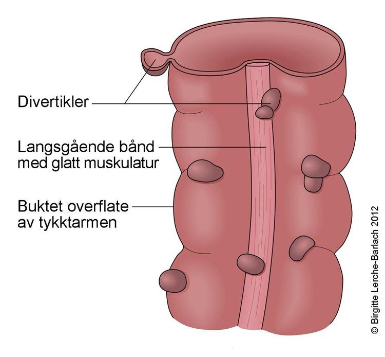 Tykktarmsdivertikler