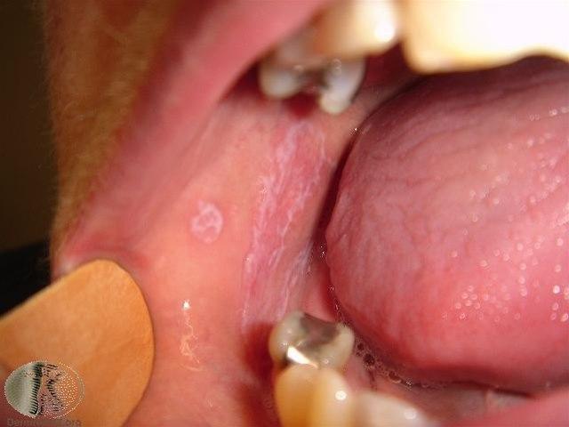 Fotoet viser lichen planus munn