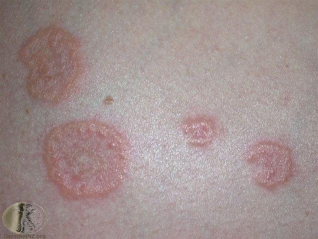 Fotoet viser svangerskaps-pemfigoid