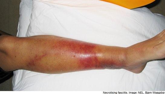 Necrotising fasciitis lower leg