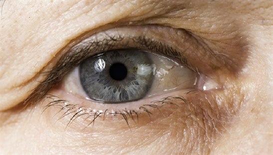 Illustrasjonsfotoet viser viser et øye med pingvekula på nasalsiden
