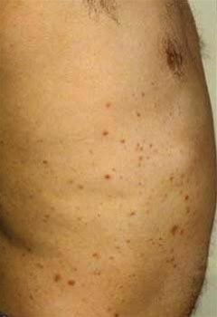 Typisk lokalisasjon av Malassezia follikulitt (tidligere benevnt Pityrosporum follikulitt eller pityriasis follikulitt). Akneliknende papler og pustler på øvre del av trunkus.