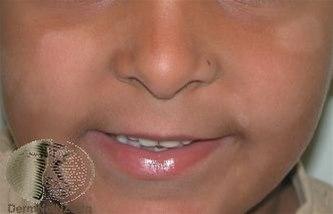 Fotoet viser nærbildet av et barns ansikt. Det sees klassiske flekker med redusert pigmentering på kinn, hake og ved munnen.