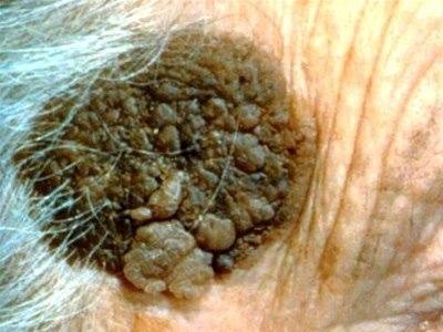 Seboréisk keratose er en tumor i epidermis. Dette er en brungrå, verrucøs hudlesjon med fet, lett skjellende hudoverflate. Dermatoskopi viser små talgcyster i epidermis.