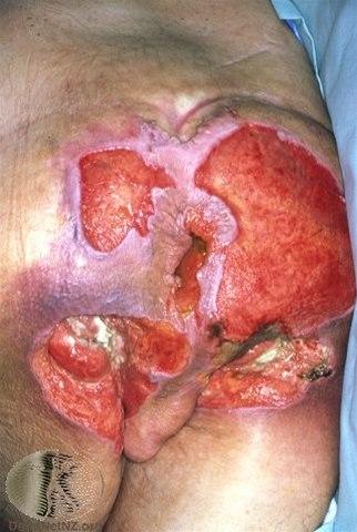 Fotoet viser trykksår