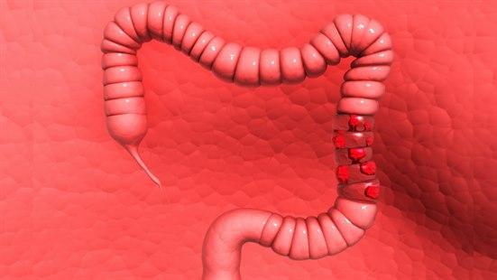 Tykktarm med polypper