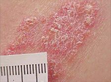 Psoriasis, plaque