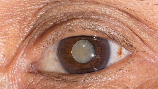 Cataract