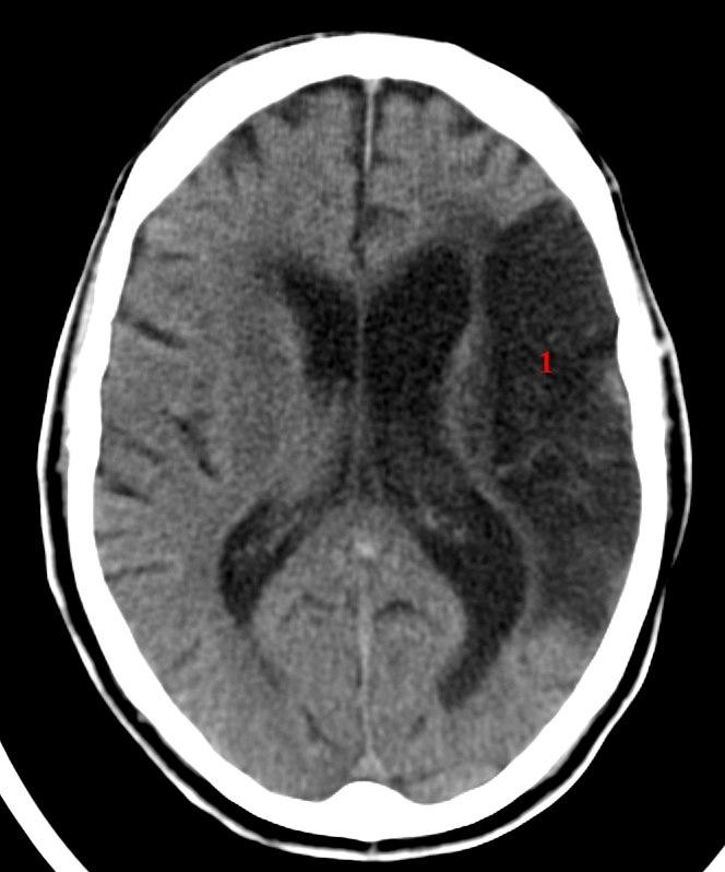 Cerebralt infarkt media (CT)