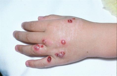 Orf disease, hand