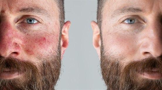 To bilder i ett av en person med rødflammet rosacea på det ene bildet og normal hud på det andre.