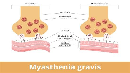 Myasthenia gravis