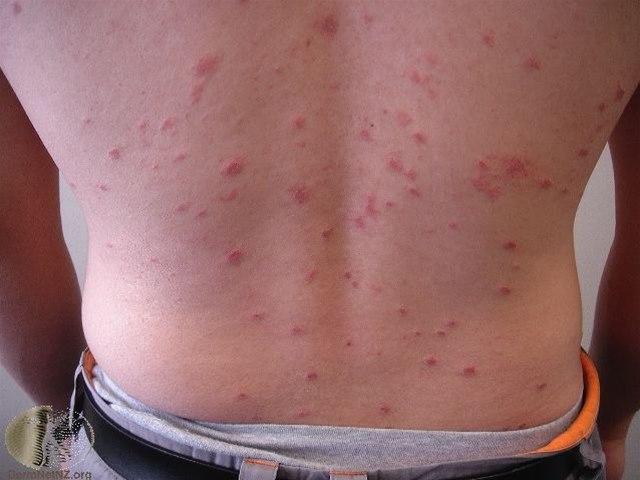 Fotoet viser pityriasis rosea, utslett
