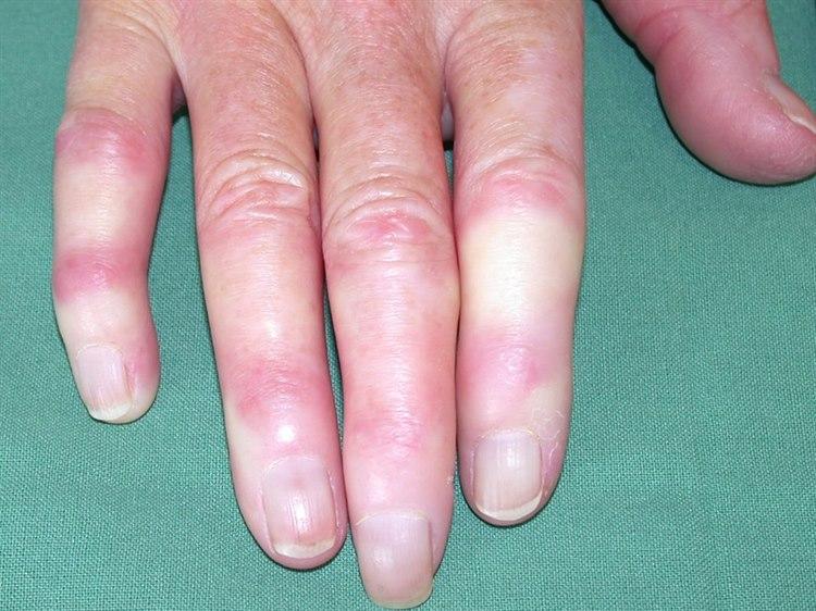 Fotoet viser nærbilde av fingertupper som har tegn til Raynauds fenomen