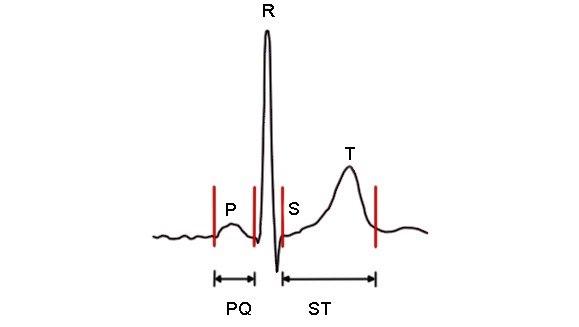 De ulike delene av EKG-komplekset