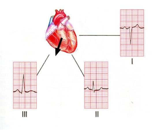 Høyre aksedeviasjon