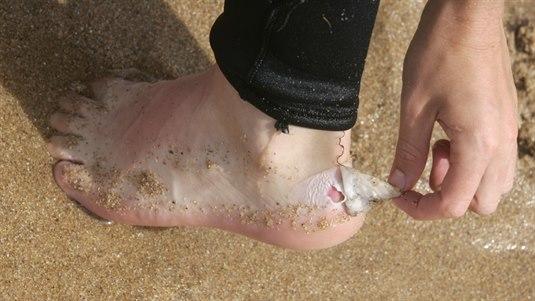 Illustrasjonsfoto av noen som river av et gnagsårplaster som er på hælen. Vi ser en liten del av gnagsåret.
