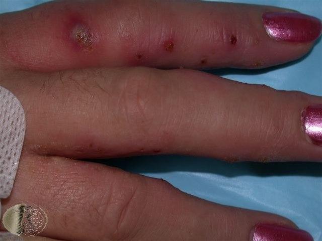 Fotoet viser pompholyx, infisert