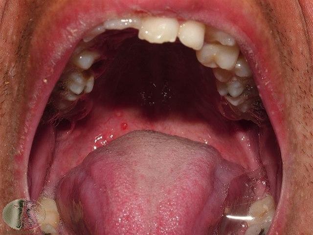 Fotoet viser vannkopper i munnhule