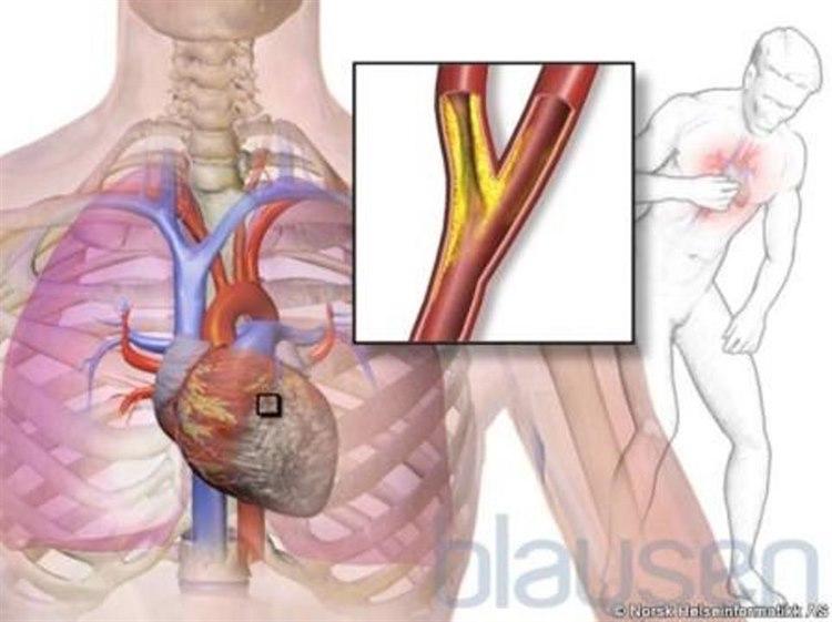 Angina pectoris