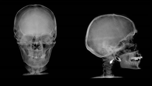 Røntgenbilde av sideprofil og baksiden av en hodeskalle