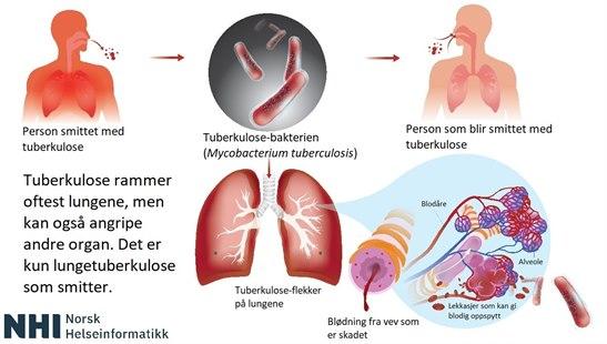 Tuberculosis