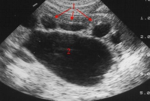 Overgangs-stenose (UL)