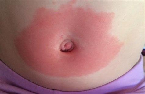 Erythema chronicum migrans, abdomen