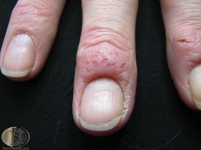 Fotoet viser paronykia