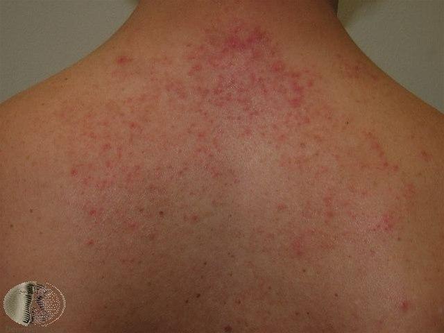 Fotoet viser malasseziafollikulitt, rygg