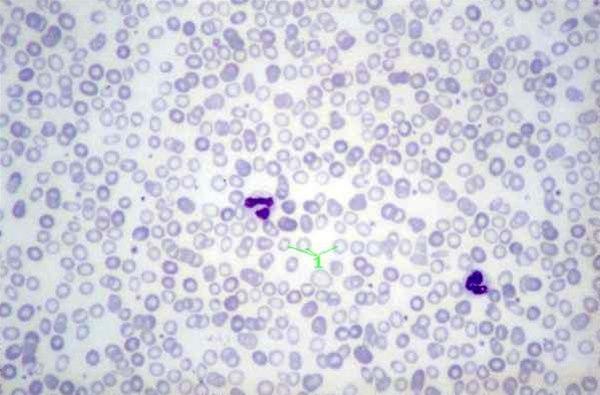 Mikroskopisk bilde av blodet ved jernmangelanemi