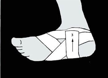 Fotsåleteiping bilde#4