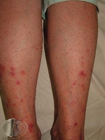 Fotoet viser soleksem på legger