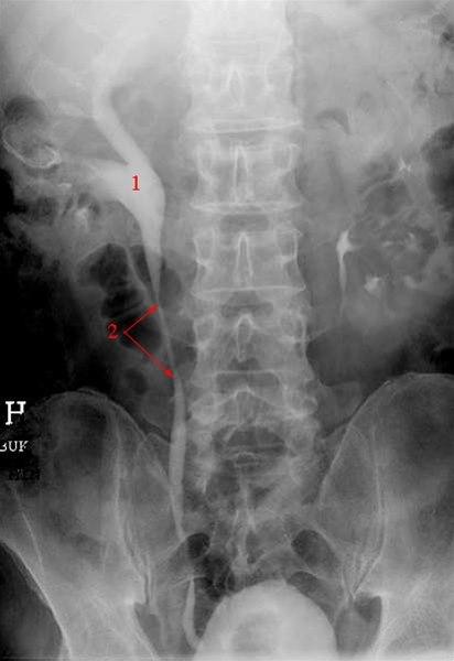 Hydronefrose vist på røntgen