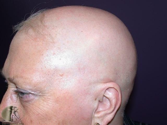 Fotoet viser alopesia, totalis