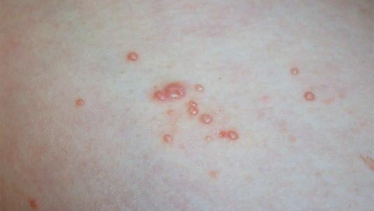 Molluscum contagiosum